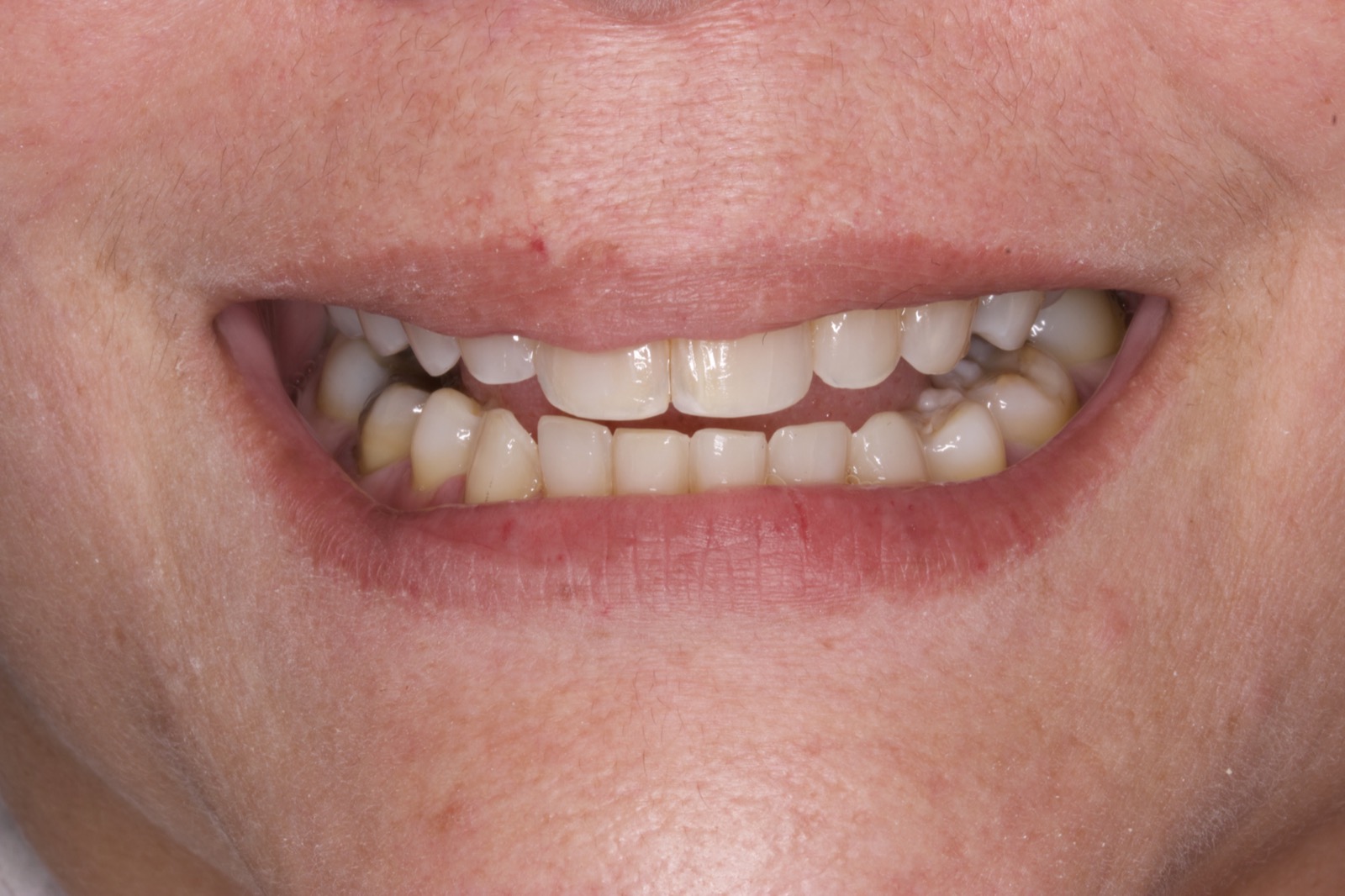 Maricel — before treatment