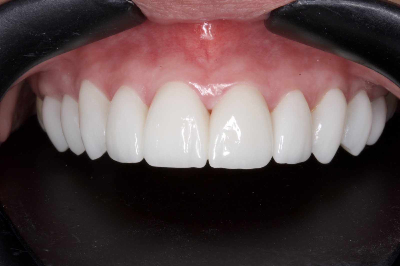 Maricel — upper ceramic veneers